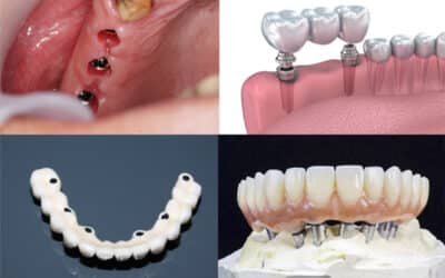 Implantes dentales cuando faltan piezas dentales