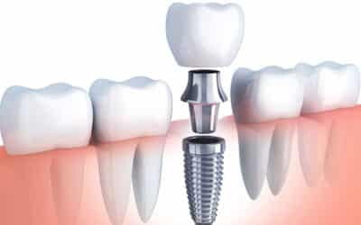 ¿Cuánto vale un implante dental?