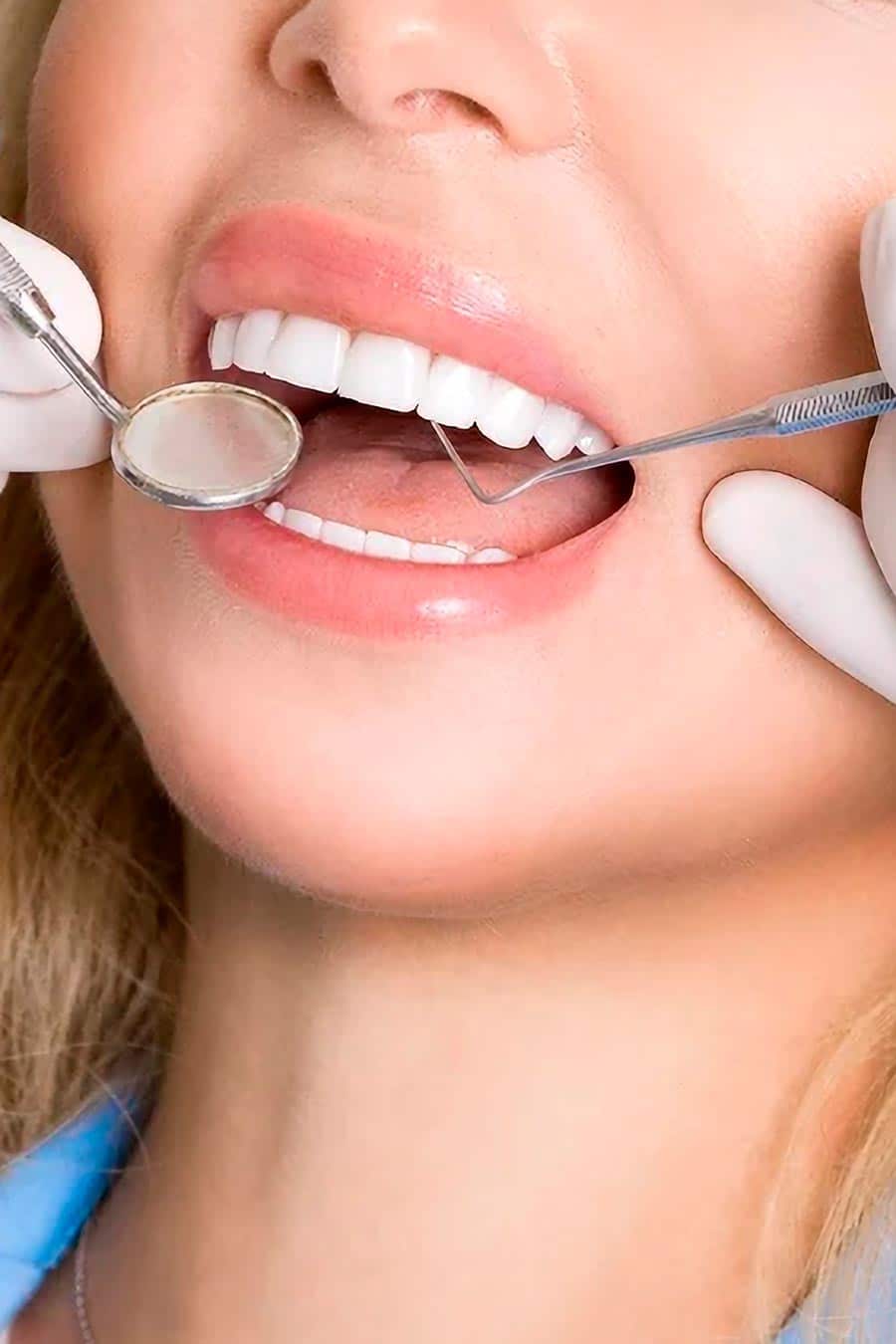 Carillas Dentales en Hortaleza - Clínica Orgaz Dental