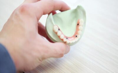 Prótesis dentales fijas sin implantes: guía completa