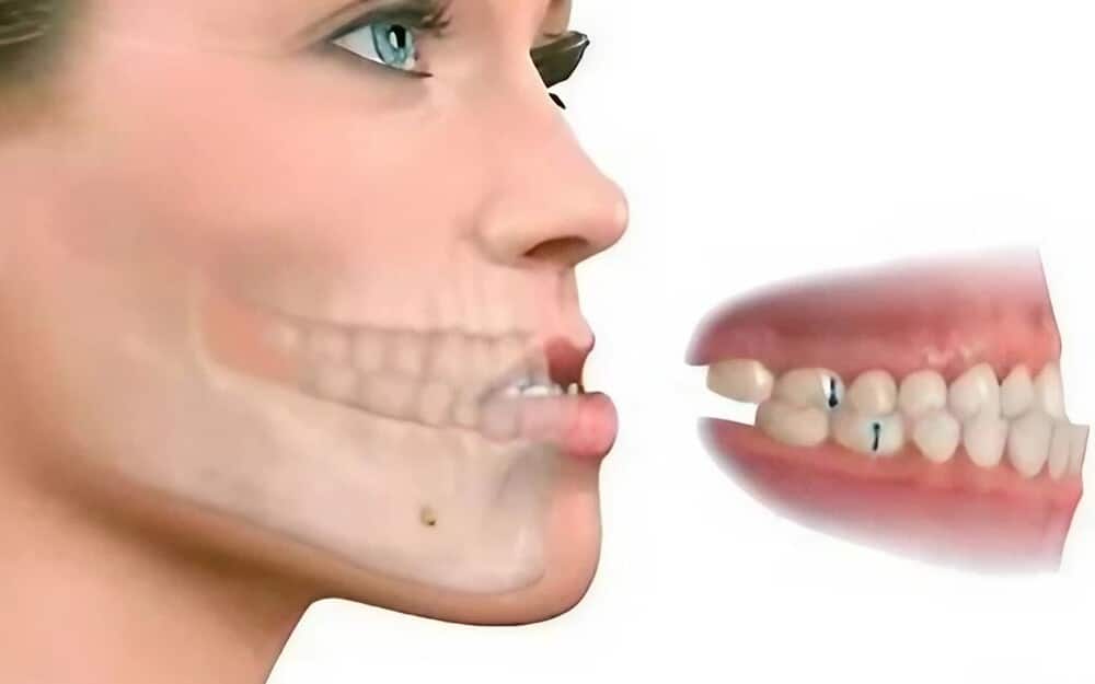 Tipos de maloclusión: identificando problemas de alineación dental