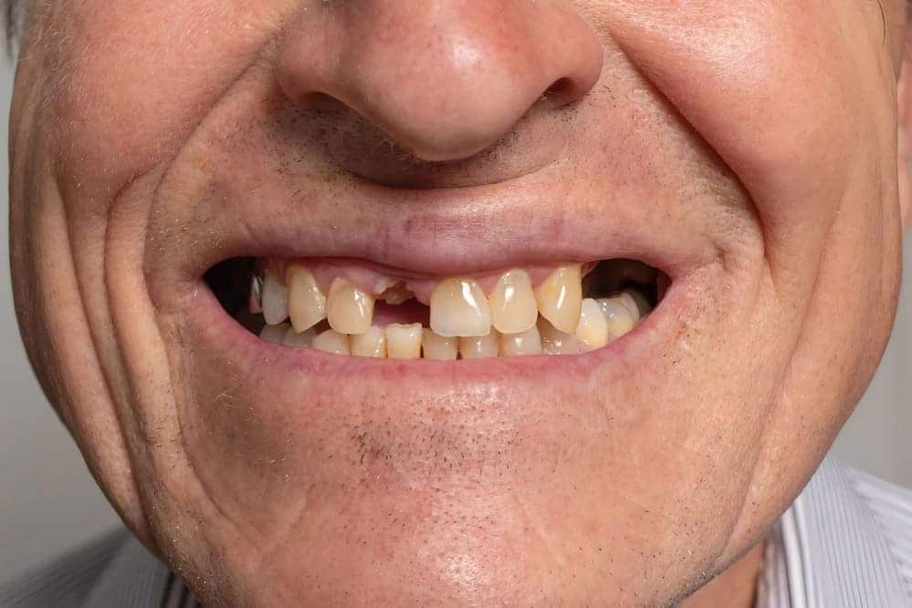 anciano con perdida dental