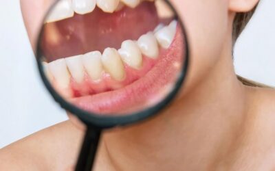 Abrasión dental: causas y tratamiento