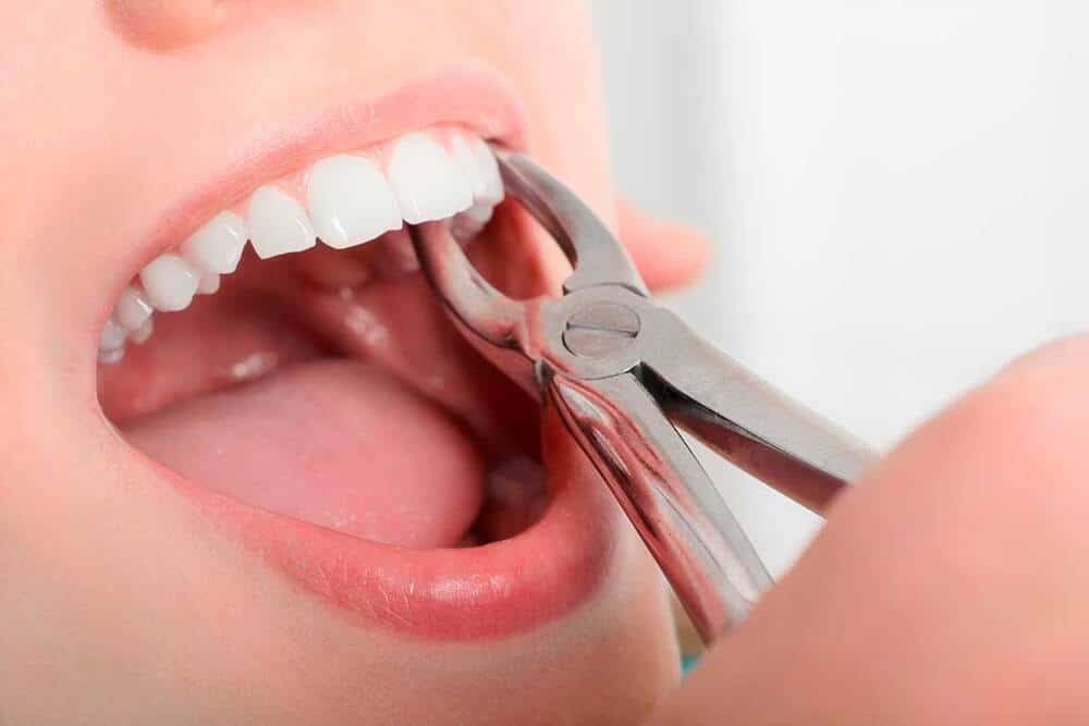 extracción dental boca paciente mujer