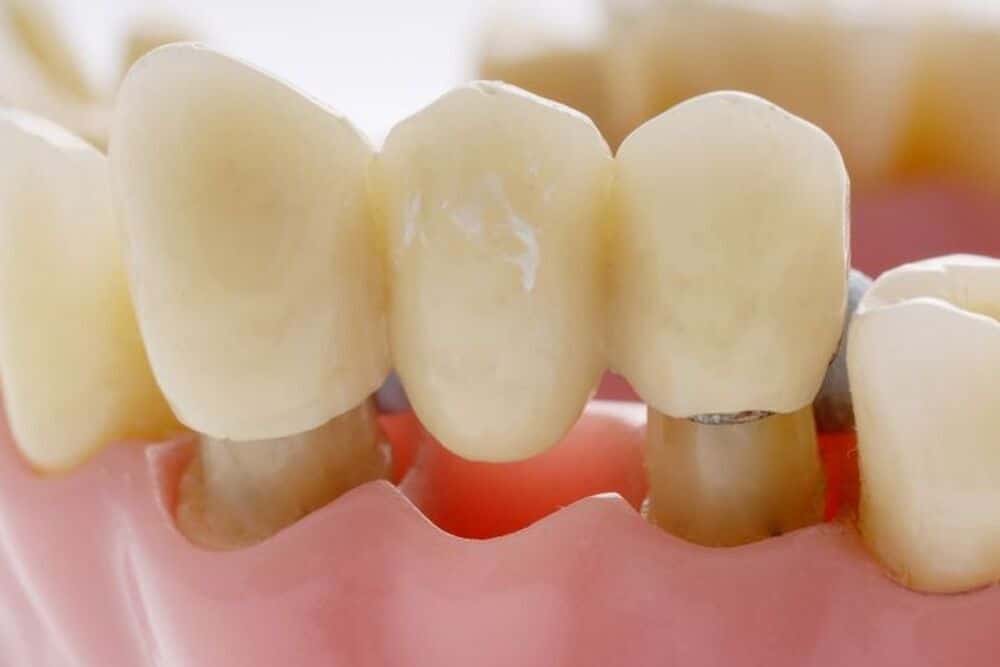 primer plano puentes dentales boca paciente