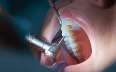 Precio de la endodoncia