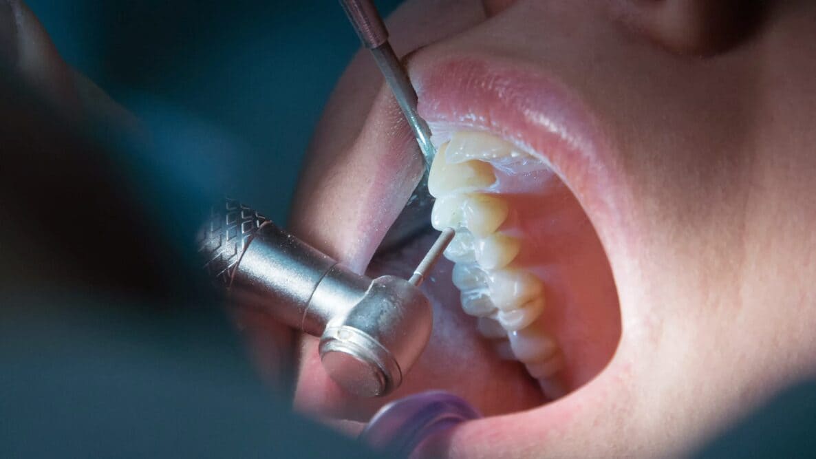 dentista practicando endodoncia paciente