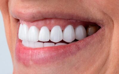 Carillas dentales de porcelana mínimamente invasivas