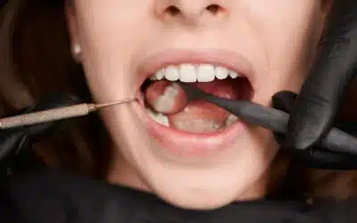 Caries dental: La guía más completa