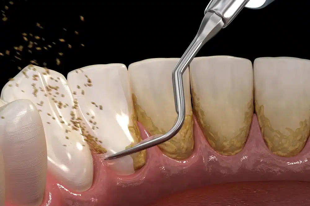 quitando sarro herramienta odontologica