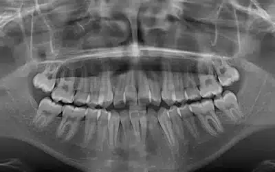 Radiografía digital en odontología: Qué es y beneficios