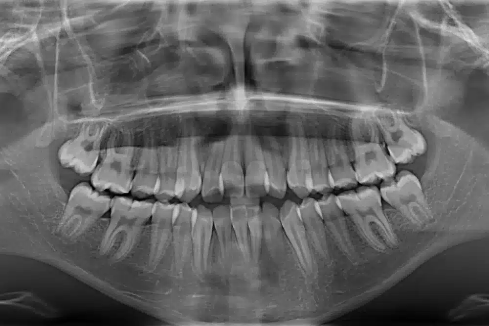 Radiografía digital en odontología: Qué es y beneficios