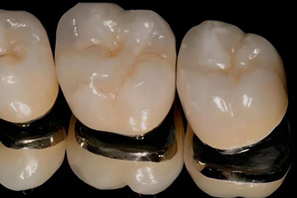 puentes-de-metal-porcelana-ziortza-ugarte