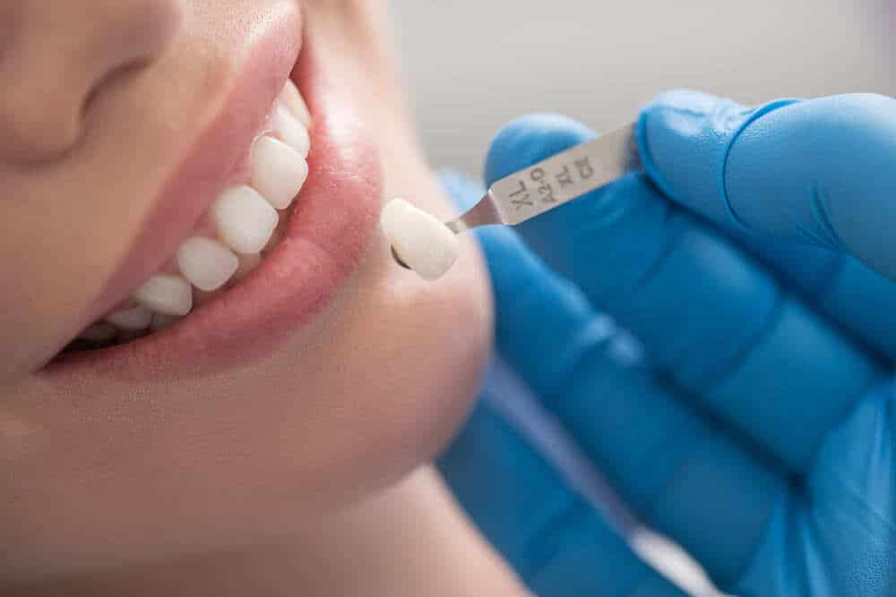 colocacion coronas porcelana dental clinica sonrisa