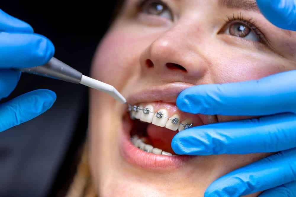 detalle de boca de paciente con brackets recibiendo revision dental con guantes