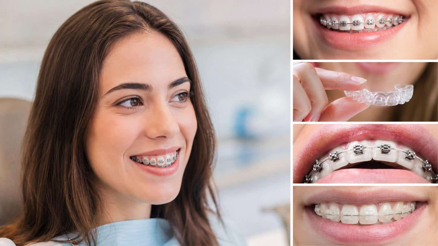 Collage of dental treatments featuring a woman with metal braces and close-ups of clear aligners, lingual braces, and ceramic braces.