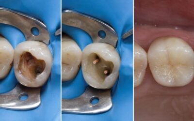 Endodoncia antes y después