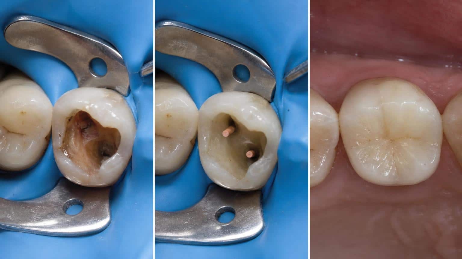 Three-panel sequence showing a decayed molar, the root canal filling process with gutta-percha points, and the final restored tooth.