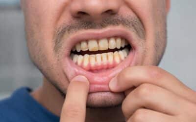 Manchas en los dientes: guía completa