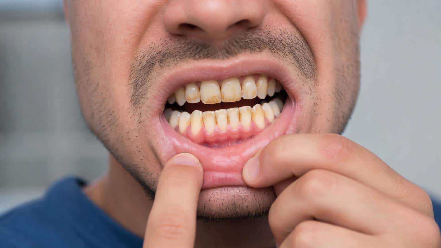 Close-up of a person pulling down their lower lip to reveal yellowed teeth with prominent brown stains and plaque buildup.