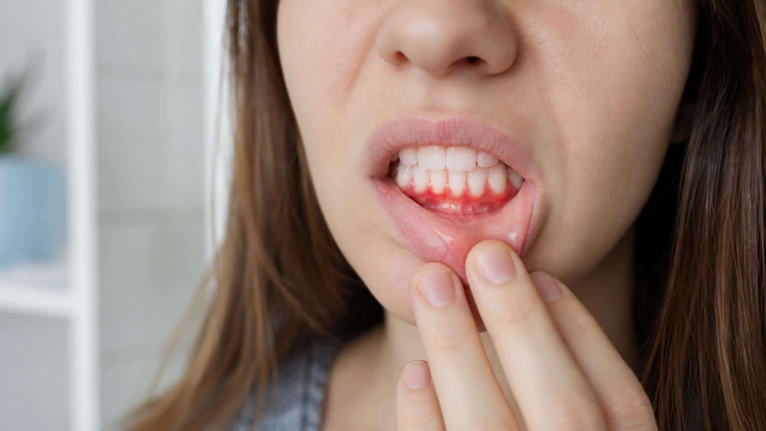 Close-up of a woman pulling down her lower lip to reveal red, inflamed, and bleeding gums around her bottom teeth.